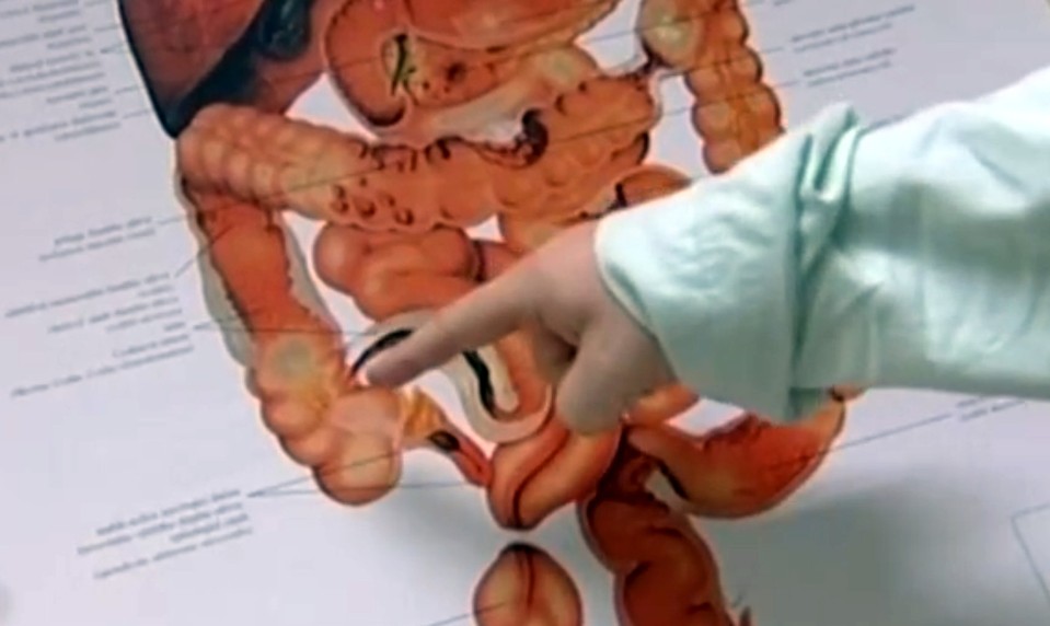 Trápi vás NADMERNÁ PLYNATOSŤ? Môže byť príznakom až 8 chorôb postihujúcich črevá!