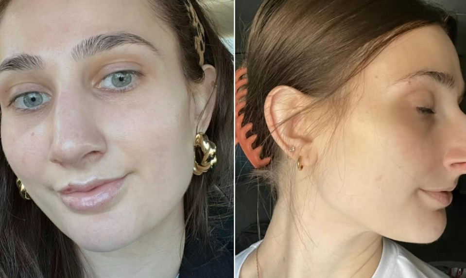 Obrovský nos ako TUKAN jej ničil sebavedomie: Operácia za 10-tisíc jej zmenila život!