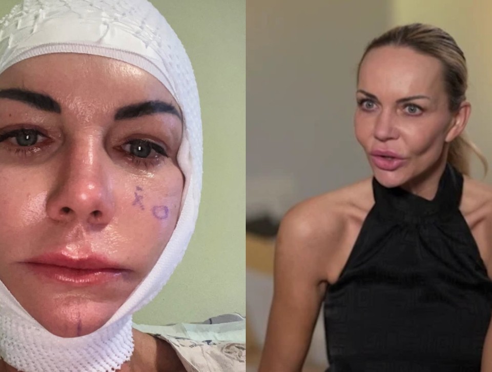 ŠOK po facelifte Moniky Nemčokovej: Ochabla jej časť tváre! TAKTO vyzerá dnes