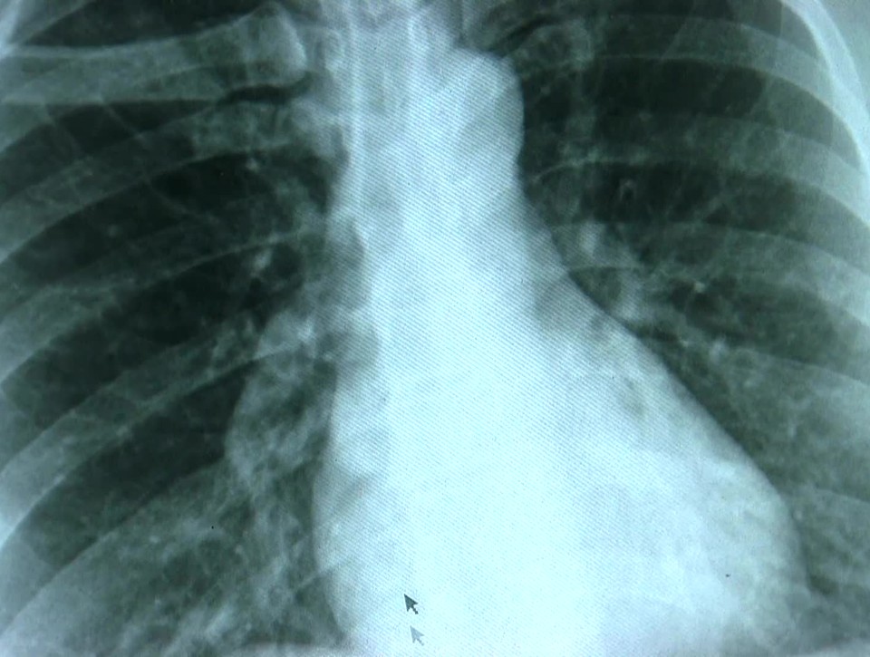 NENÁPADNÝ ZABIJAK:  Rakovinu pľúc ľudia často považujú za pretrvávajúcu infekciu
