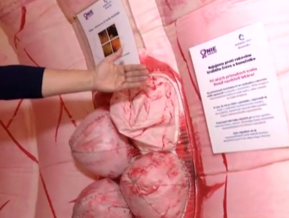 Slováci a rakovina hrubého čreva: Milujeme ultraspracované mäso, tvrdí známy lekár